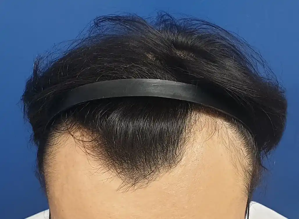 M자 탈모 모발이식 3000모 비용 상담을 위해 이마 라인을 확인하는 남성