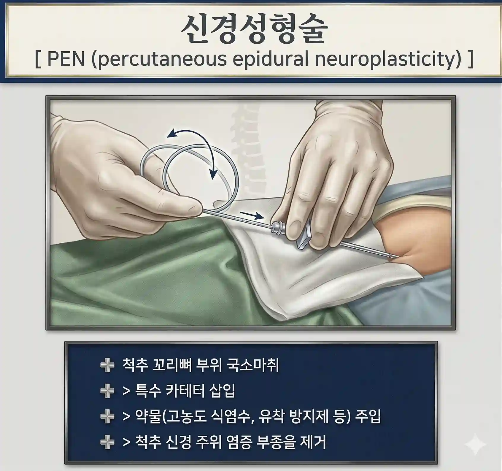 신경성형술 PEN (percutaneous epidural neuroplasticity)이라는 텍스트와 함께 척추 꼬리뼈 부위 국소마취 후 특수 카테터를 삽입하여 약물을 주입하고 염증 부종을 제거하는 시술 과정을 전문적으로 설명하는 일러스트가 담긴 대표 이미지